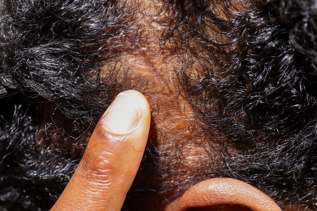 A finger pointing to a scar on a person's scalp.