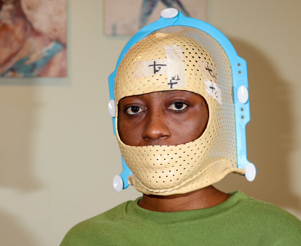 Elizabeth Fleurisma wears a lead mask used during radiation treatment.