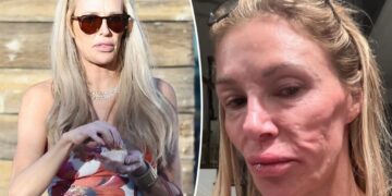 ‘Thrilled’ Brandi Glanville says she finally received diagnosis for face disfigurement after blaming parasite