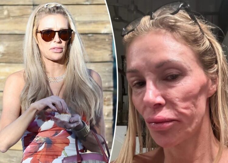 ‘Thrilled’ Brandi Glanville says she finally received diagnosis for face disfigurement after blaming parasite