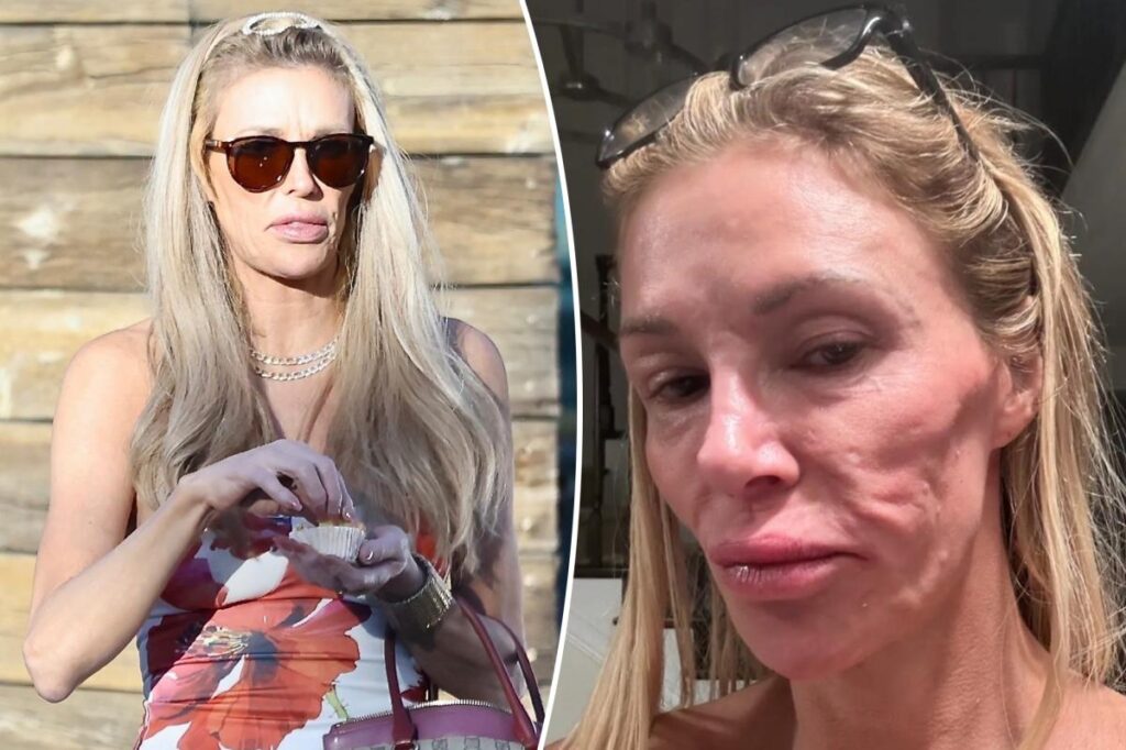 ‘Thrilled’ Brandi Glanville says she finally received diagnosis for face disfigurement after blaming parasite