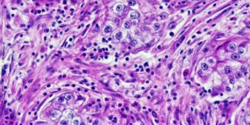 Doctors Catch Cancer-Diagnosing AI Extracting Patients’ Race Data and Being Racist With It