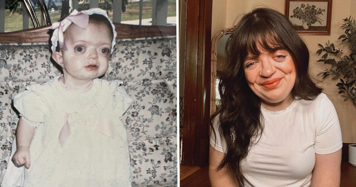 I spent years trying to hide my face. Today, I’m a proud woman who embraces my facial differences.