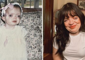 I spent years trying to hide my face. Today, I’m a proud woman who embraces my facial differences.