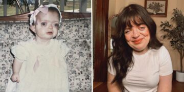 I spent years trying to hide my face. Today, I’m a proud woman who embraces my facial differences.