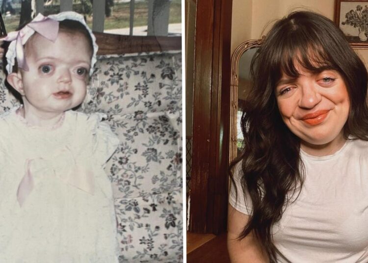 I spent years trying to hide my face. Today, I’m a proud woman who embraces my facial differences.