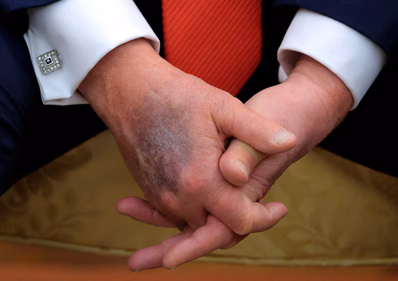 WASHINGTON, DC - AUGUST 25: A bruise is visible on the back of U.S. President Donald Trump's right hand during a meeting with  South Korean President Lee Jae-myung in the Oval Office at the White House on August 25, 2025 in Washington, DC. White House Press Secretary Karoline Leavitt was asked about the bruising in February and she responded, 