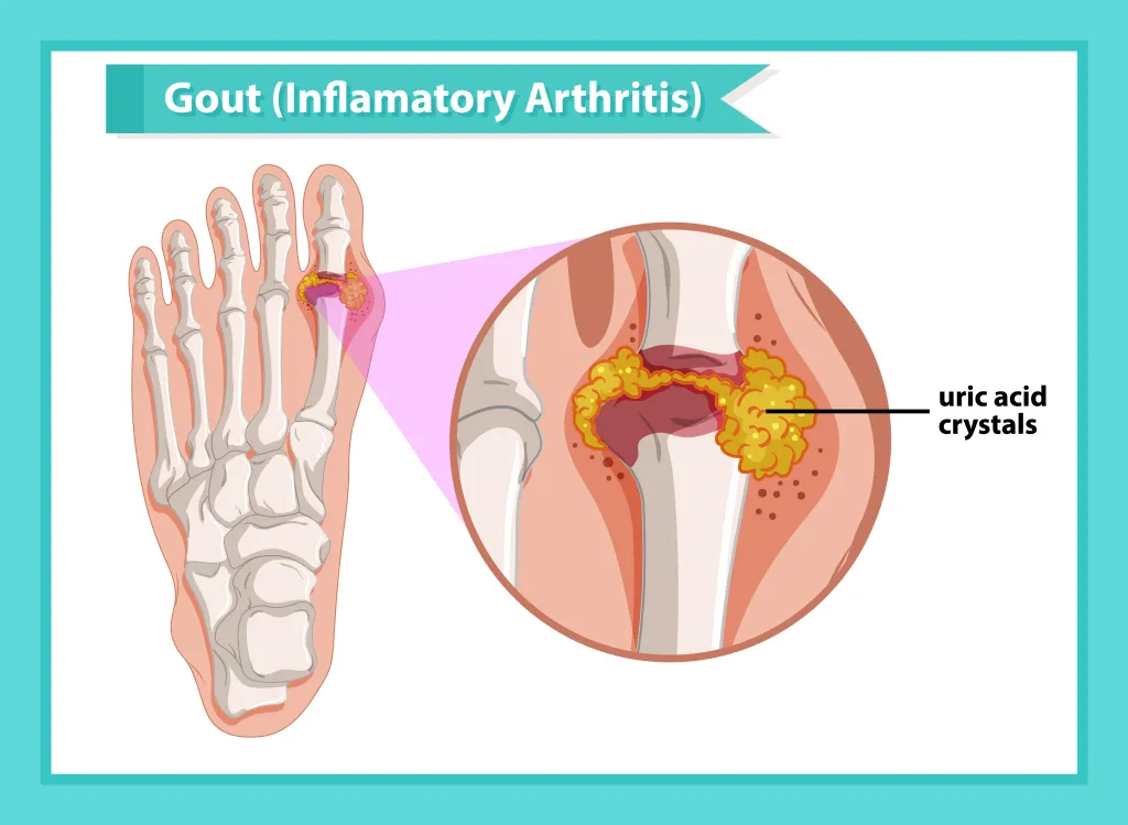 Illustration of the bones in a foot with an enlargement showing uric acid crystals in the joint of the big toe, labeled as gout (inflammatory arthritis).