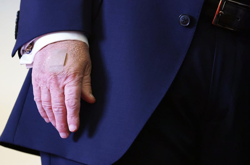 U.S. President Donald Trump sports a bandage on his right hand at an event at Mount Airy Casino Resort on December 9, 2025 in Mount Pocono, Pennsylvania.