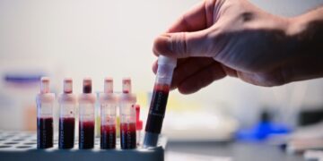 Small study shows a promising path toward HIV cure