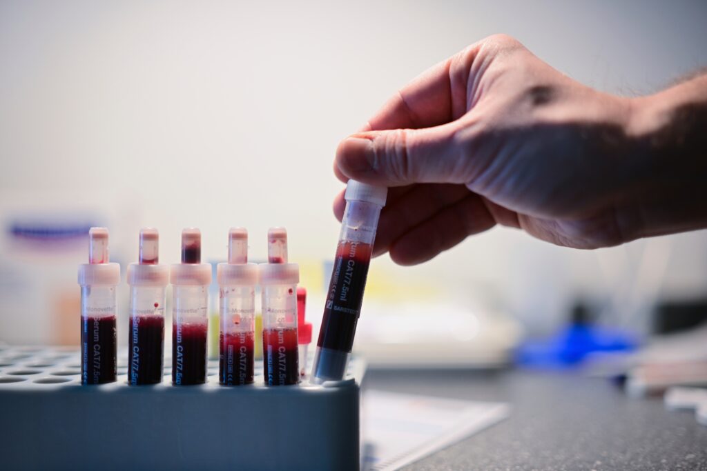 Small study shows a promising path toward HIV cure