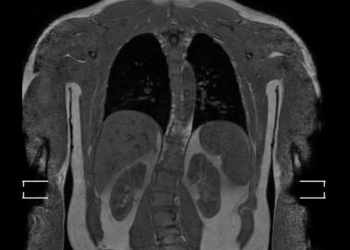 A full-body MRI can reveal hidden killers. Do we want to know?