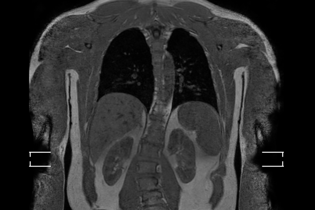 A full-body MRI can reveal hidden killers. Do we want to know?