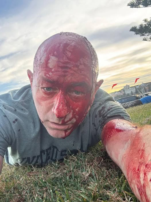 Arsen Ostrovsky covered in blood after the attack on Bondi Beach.