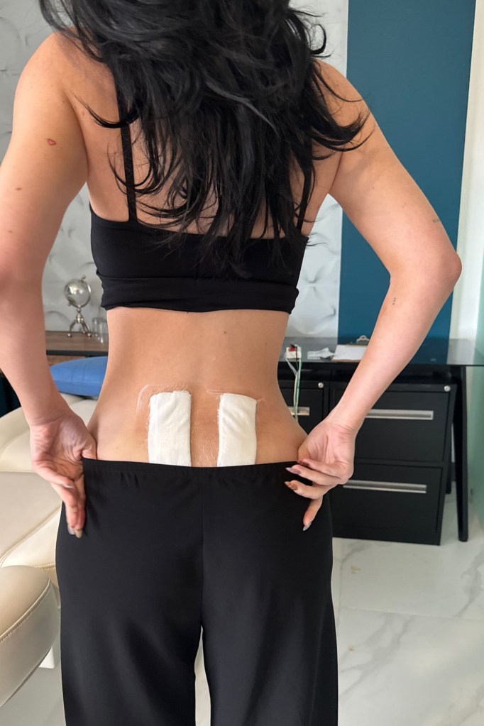 Kylie Jenner with bandages on her lower back for stem cell treatment.