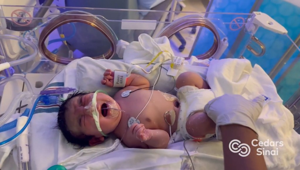 A newborn baby, connected to medical equipment, lies in an incubator at Cedars-Sinai Hospital.