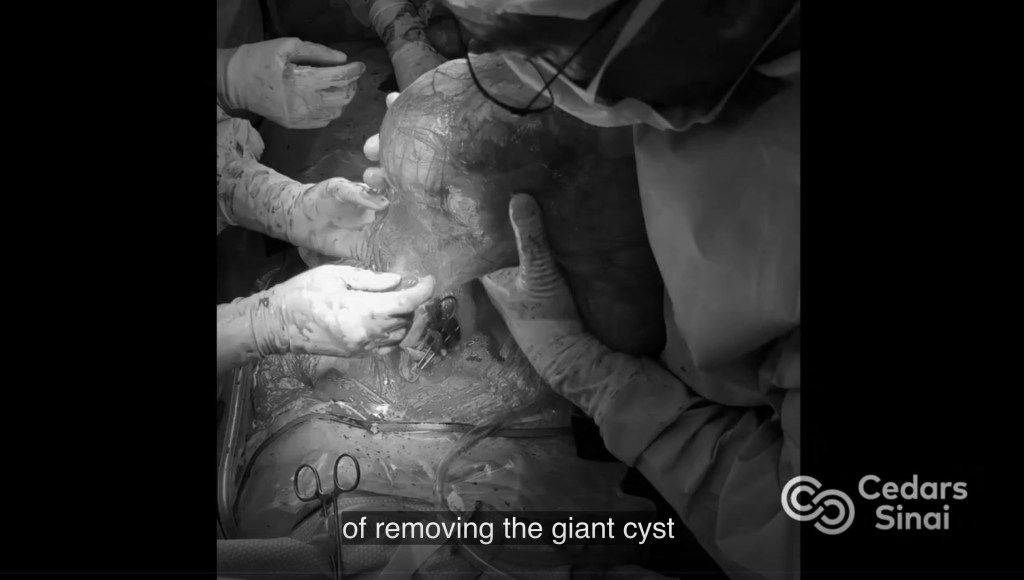 Medical professionals performing a surgery to remove a 22-pound ovarian tumor.