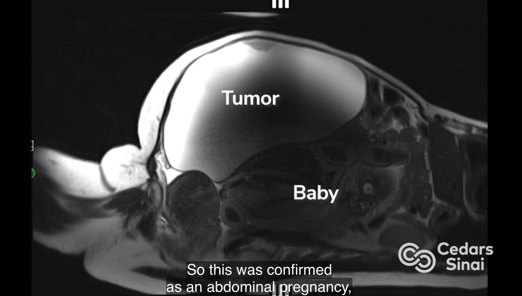 Medical scan showing a baby and a large tumor inside a body.