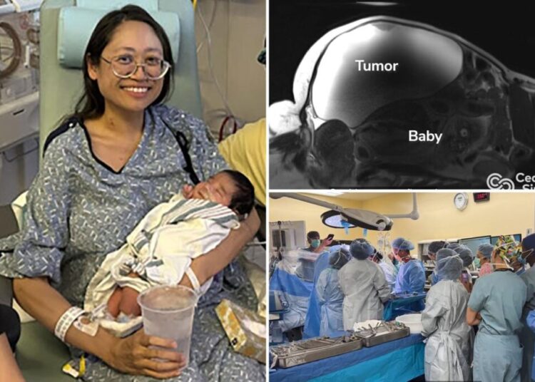 Doctors deliver ‘miracle’ baby while removing 22-pound tumor from mother