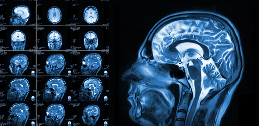 Collage of medical images showing several magnetic resonance imaging (MRI) scans of a brain in various views, appearing normal.