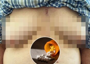 76-year-old man grows breasts after taking common medication used to treat high blood pressure, hair loss