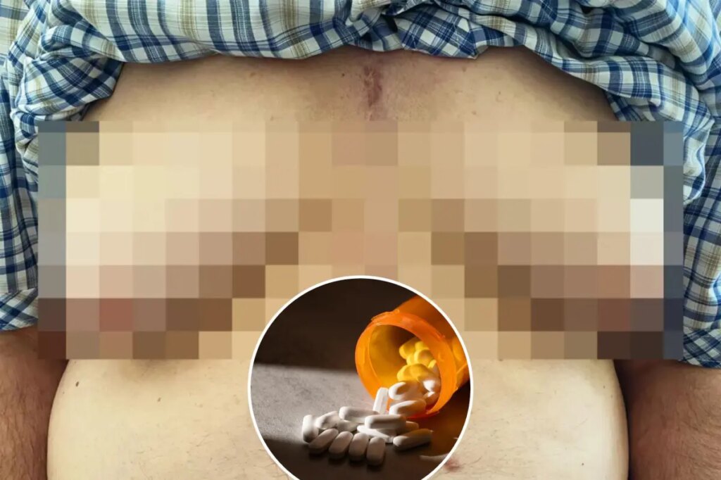 76-year-old man grows breasts after taking common medication used to treat high blood pressure, hair loss