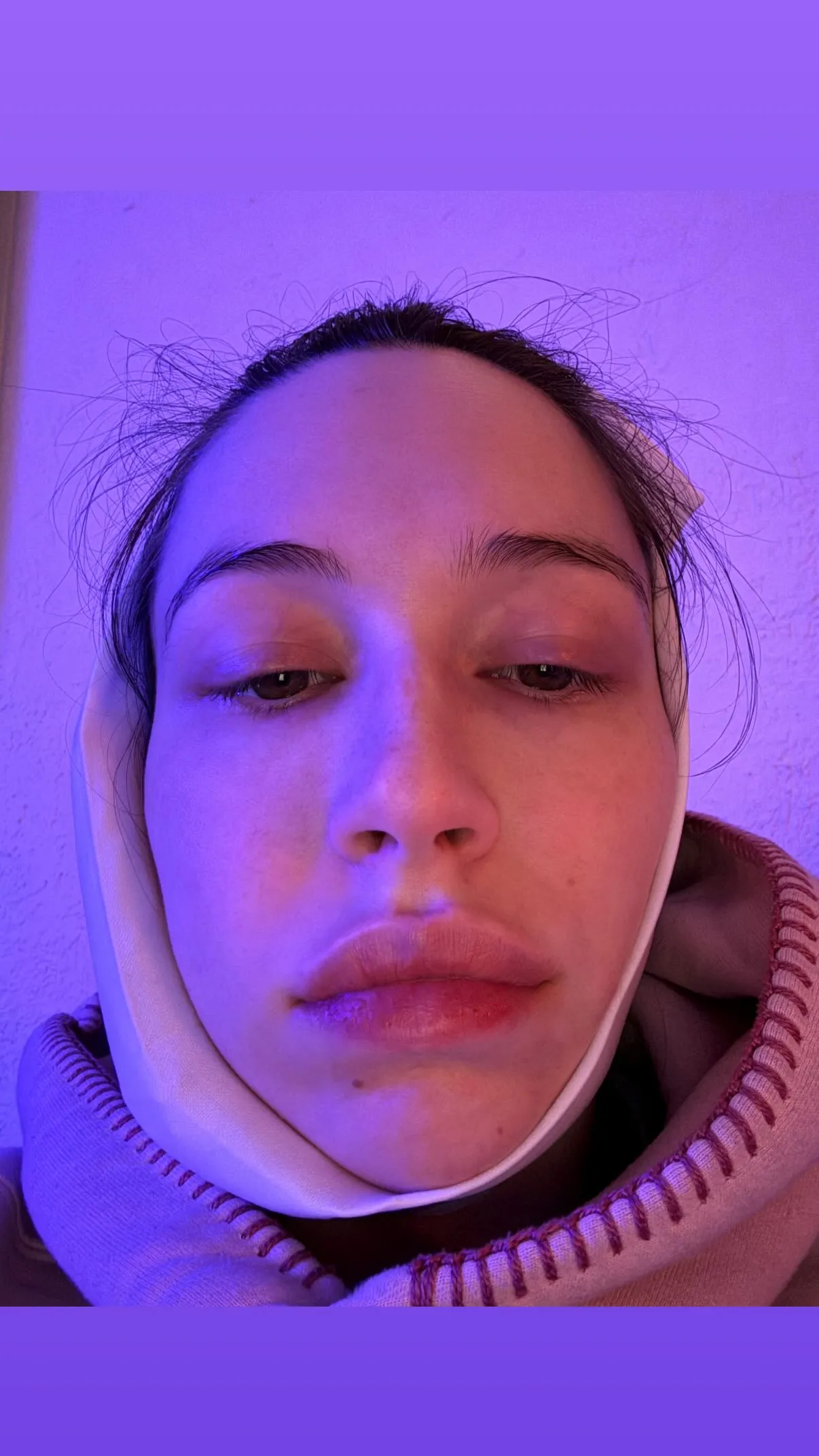 Elsie Hewitt with a bandage wrapped around her jaw, looking downcast after a wisdom tooth extraction.