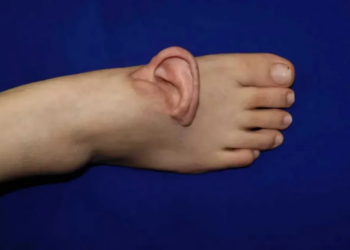Scientists Graft Human Ear Onto Foot
