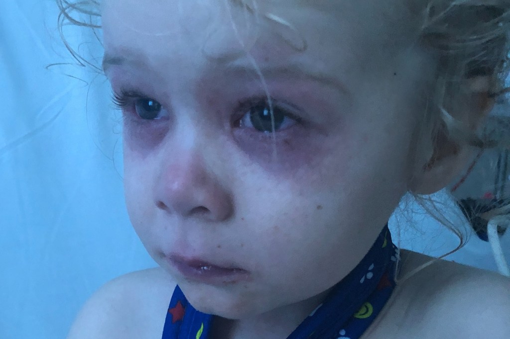 A child, Amielle, 12, or Taya, 7, with red, swollen eyes.