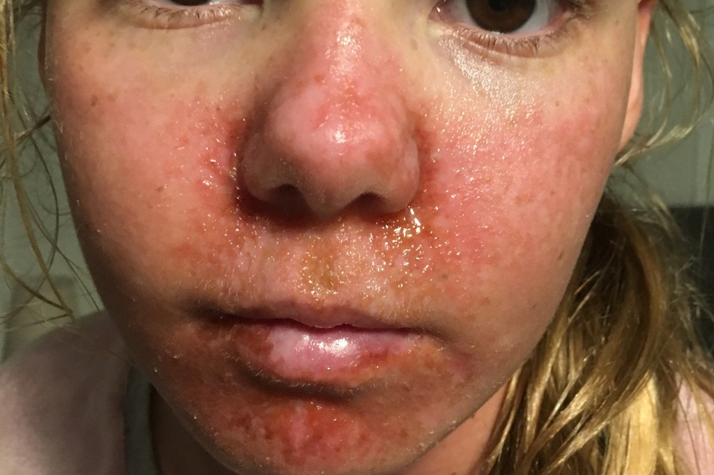 A girl's face with red, blistered skin around her nose and mouth, a symptom of Xeroderma Pigmentosum.