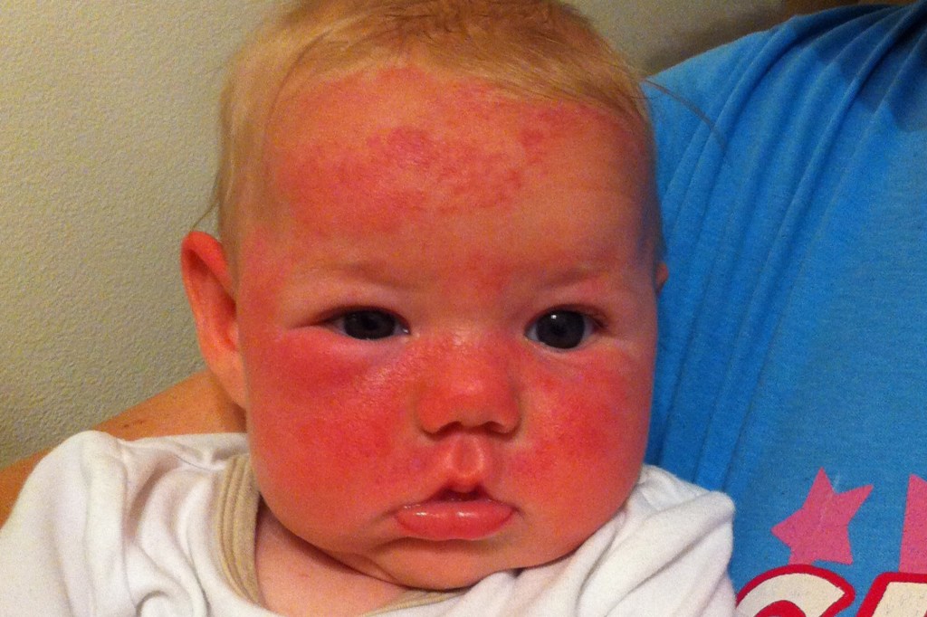A baby's face covered in red rash.