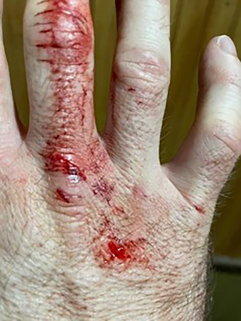A close-up of a hand with several bloody bite wounds and scratches.