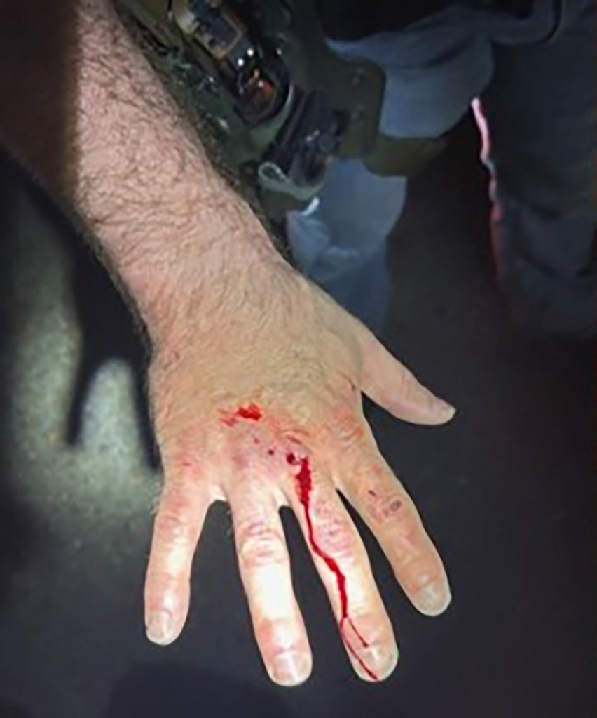 Injuries on an ICE officer's hand from a bite attack.