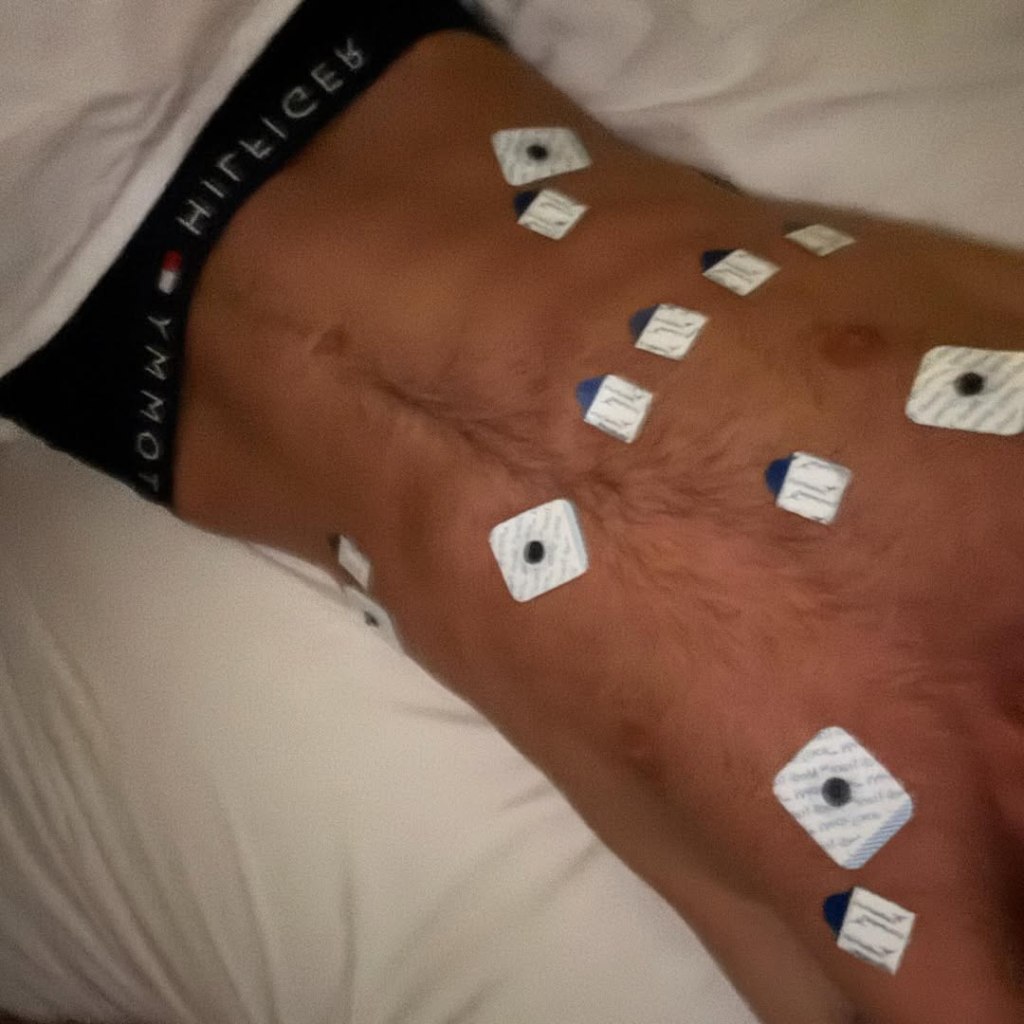 A person's torso covered in medical electrodes.