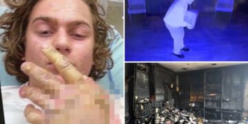 Teen accused of torching Mississippi synagogue posted hospital selfie of severe burns hours after attack