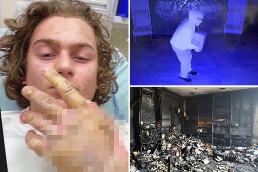 Teen accused of torching Mississippi synagogue posted hospital selfie of severe burns hours after attack