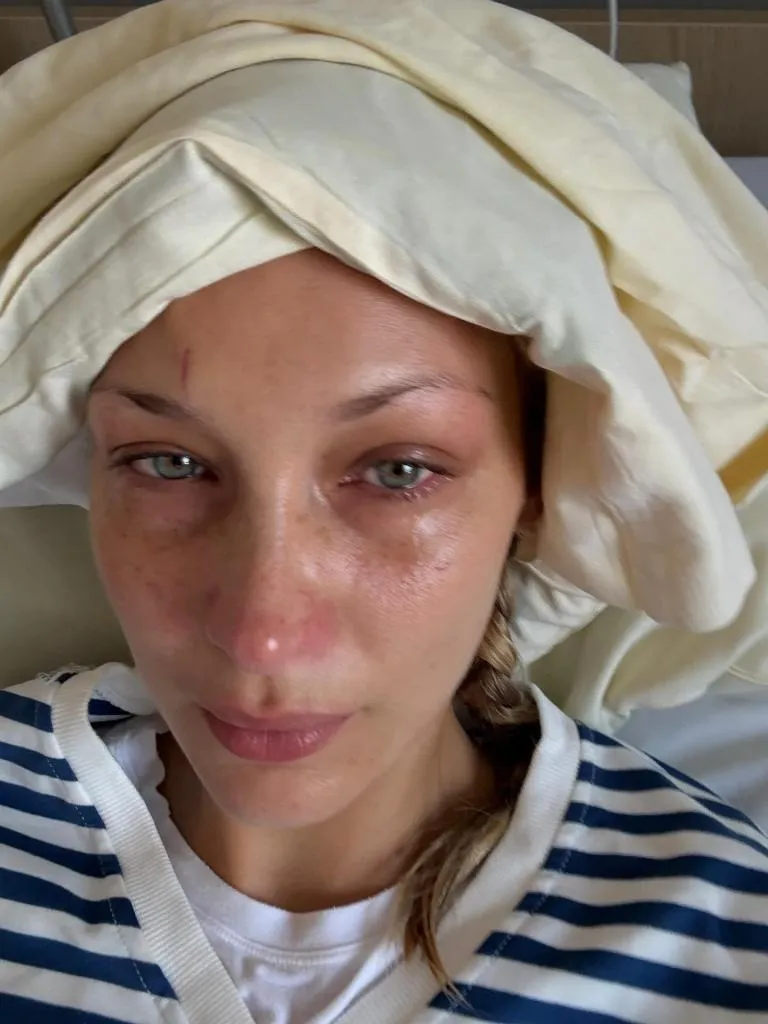 Bella Hadid in a hospital bed with her eyes red and watery, looking distressed.