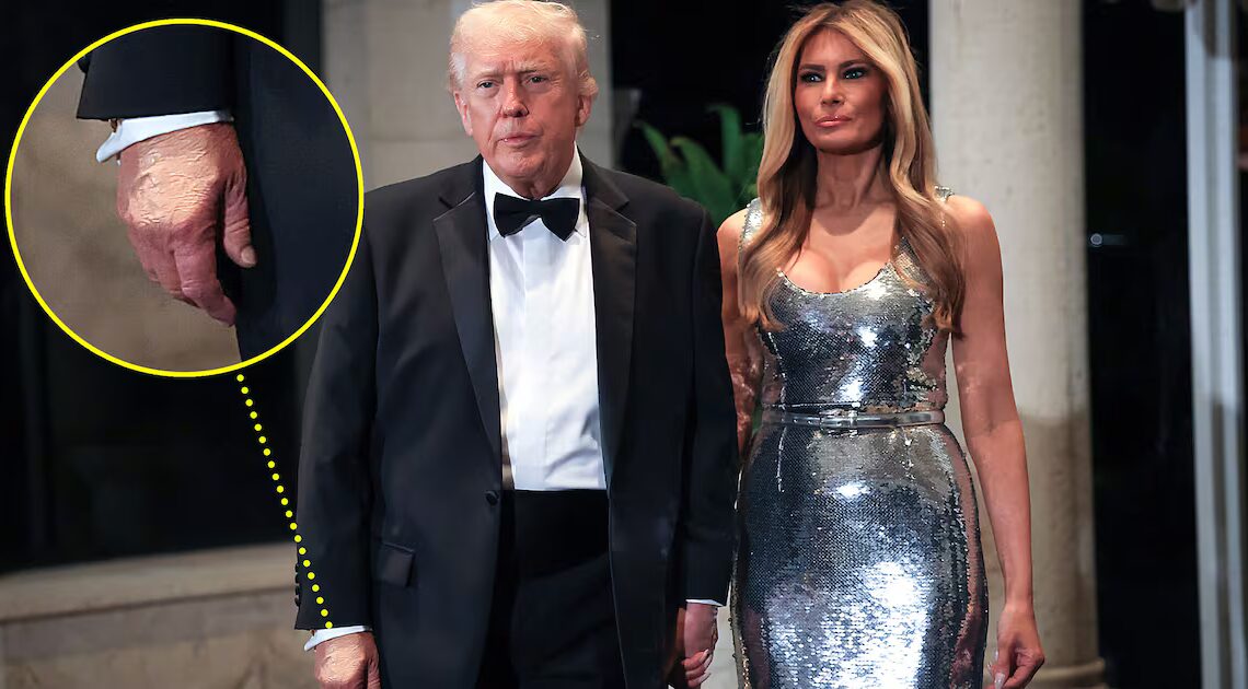 Trump, 79, Rings In The New Year With Makeup-Covered Hand