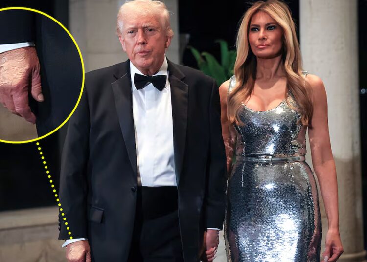 Trump, 79, Rings In The New Year With Makeup-Covered Hand