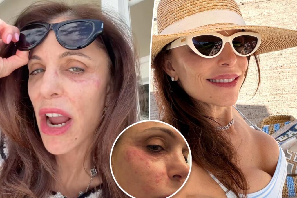 Bethenny Frankel contracts infection on face after partying in St. Barts for NYE