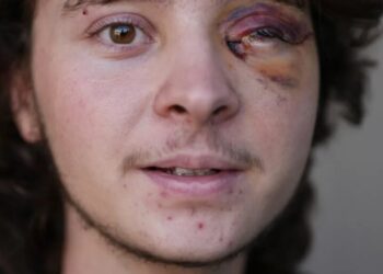 See the face of ICE’s crackdown on normal Americans: a 21-year-old college student permanently blind in one eye