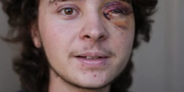 See the face of ICE’s crackdown on normal Americans: a 21-year-old college student permanently blind in one eye