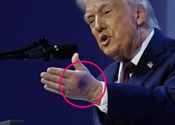 Trump’s Other Hand Is Also Now Showing a Grisly Mark