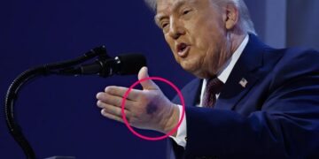 Trump’s Other Hand Is Also Now Showing a Grisly Mark