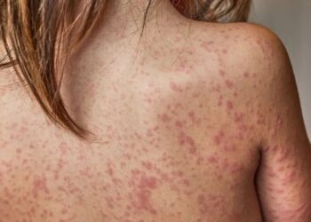 Health expert blasts Trump official for floating deadly ‘experiment’ on unvaccinated kids