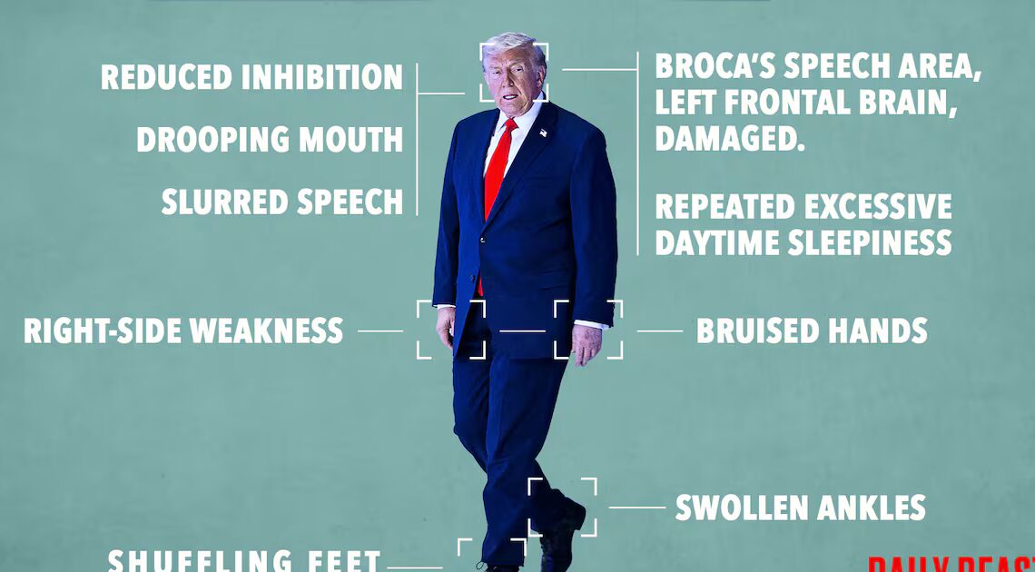 Opinion: These Are the Physical and Mental Signs Trump Has Had a Stroke: Doctor