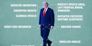 Opinion: These Are the Physical and Mental Signs Trump Has Had a Stroke: Doctor