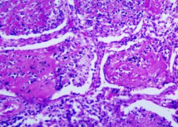 Dozens Are Sickened by a Rare Fungal Infection in Tennessee