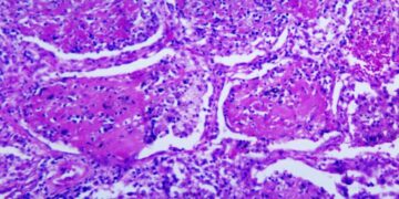 Dozens Are Sickened by a Rare Fungal Infection in Tennessee