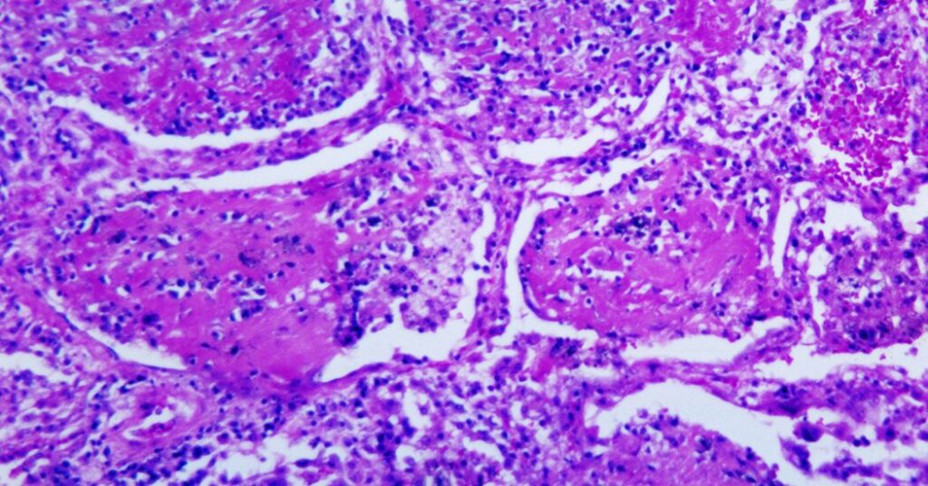 Dozens Are Sickened by a Rare Fungal Infection in Tennessee